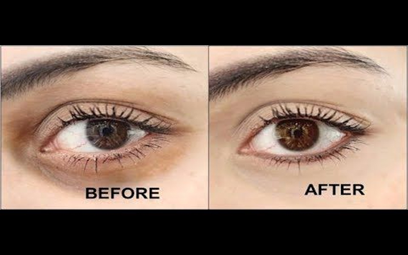 Liệu trình điều trị thâm quầng mắt bằng phương pháp cấy dưỡng chất