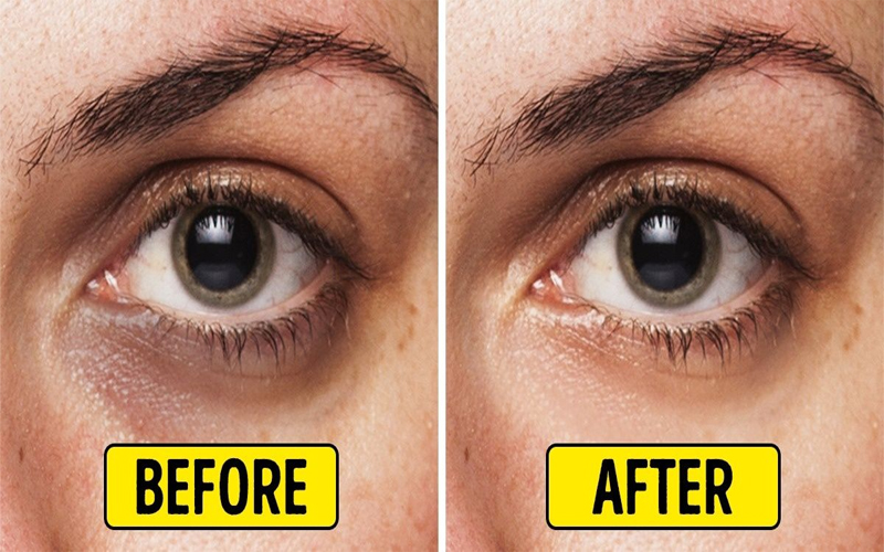 Cấy tinh chất giúp vùng da dưới mắt trở nên sáng màu hơn